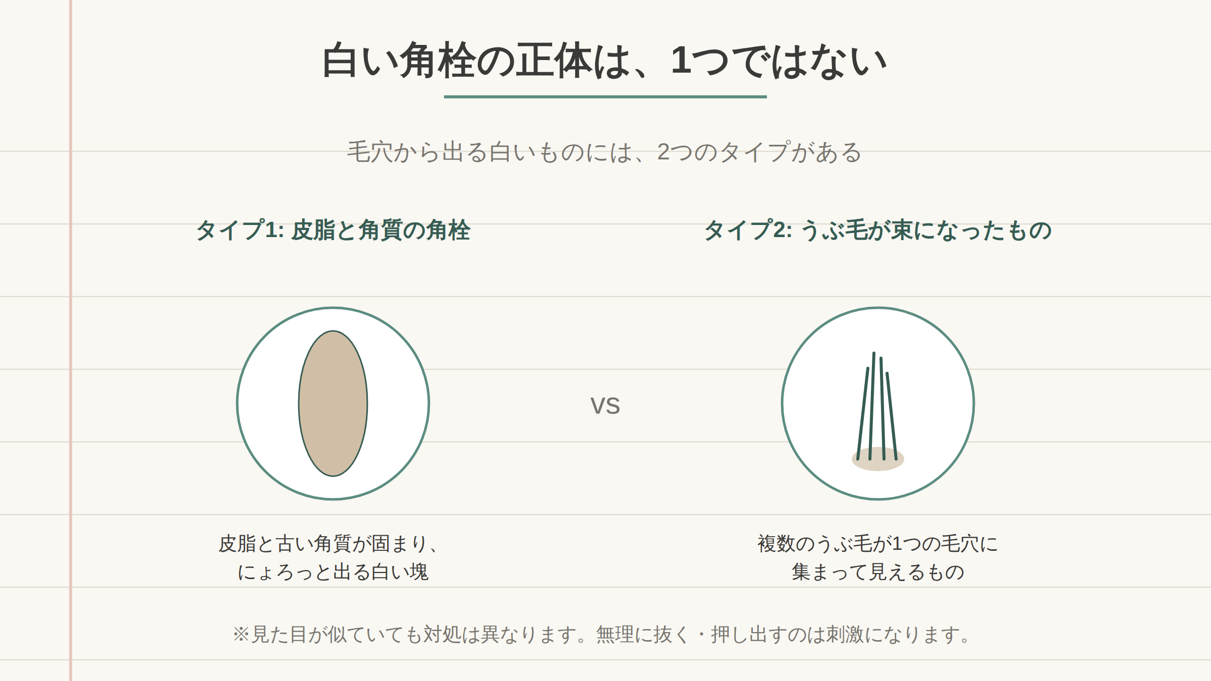 白い角栓の正体が角栓とうぶ毛の束の2種類あることを示す図解